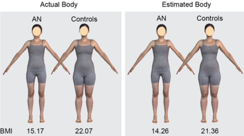 Assessing body image in anorexia nervosa using biometric self-avatars in virtual reality: Attitudinal components rather than visual body size estimation are distorted