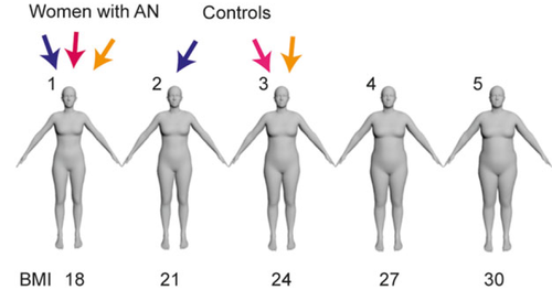Investigating Body Image Disturbance in Anorexia Nervosa Using Novel Biometric Figure Rating Scales: A Pilot Study